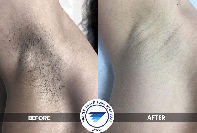 Laser Hair Removal London Simply Laser Hair Removal