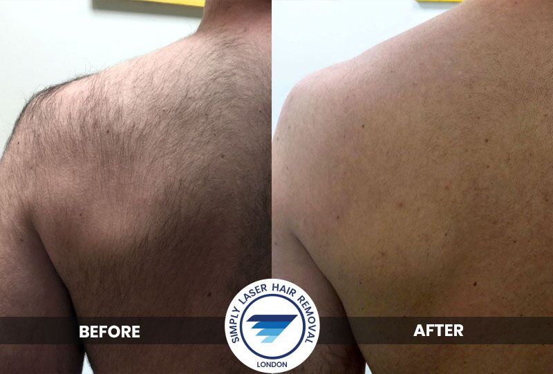 how long to see results from laser hair removal