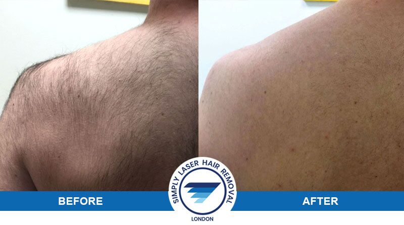 Mens Laser Hair Removal Edmonton | PHOTOTHERAPY