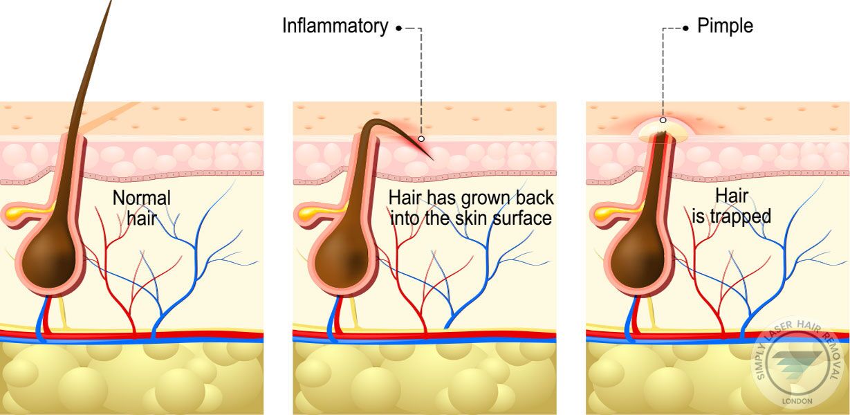 Laser Hair Removal for Ingrown Hairs